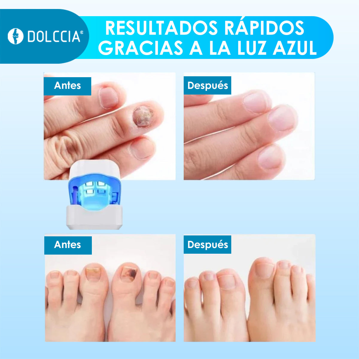 Tratamiento Láser para Restaurar Uñas DOLCCIA®